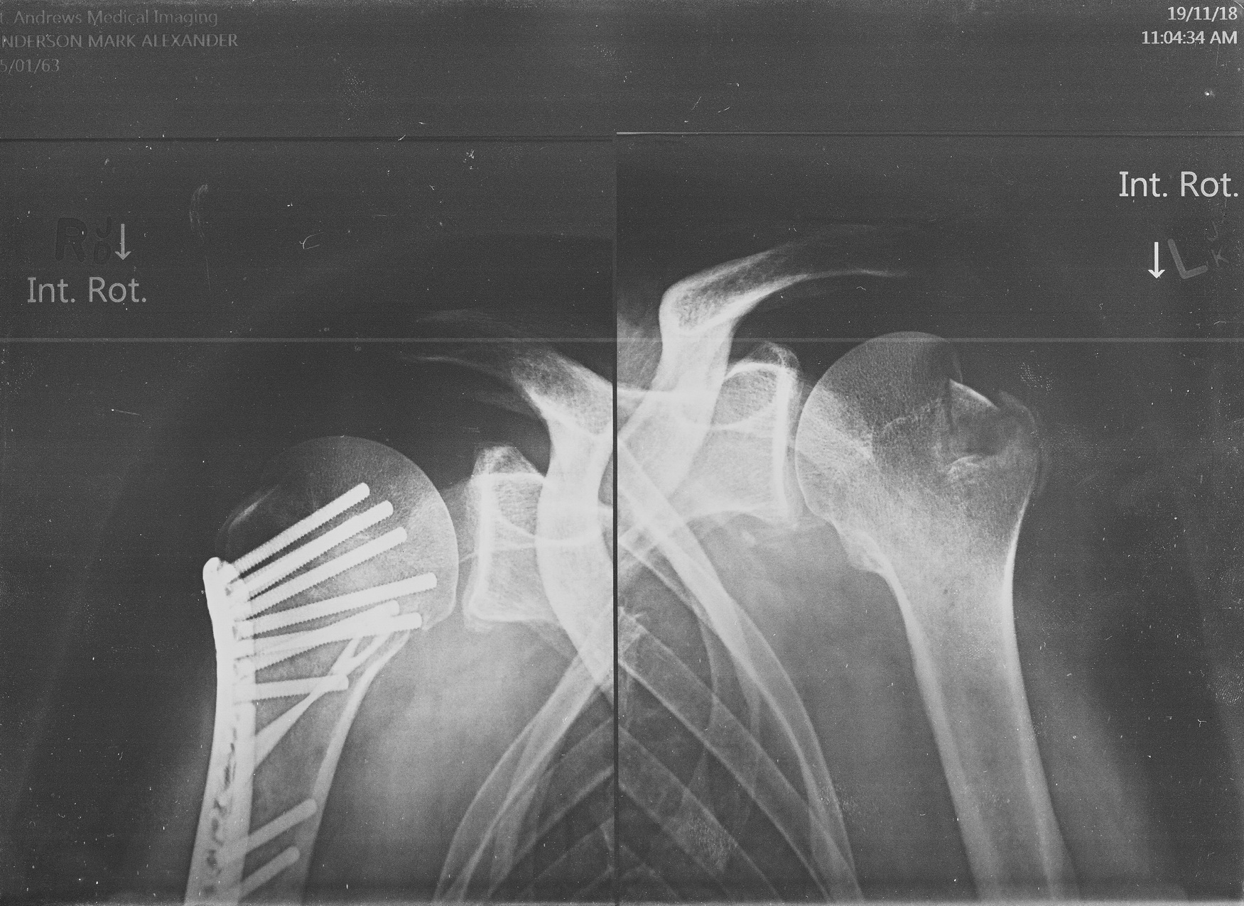 XRay of Broken Shoulder